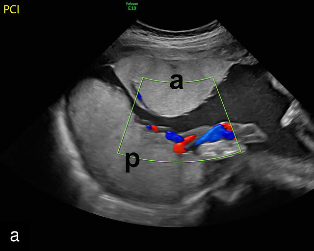 Ultrasound Evaluation Of The Placenta Umbilical Cord And Membranes ultrasound-evaluation-of-the-placenta-umbilical-cord-and-membranes